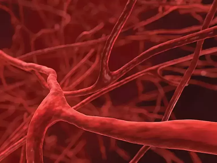 Woman thought headaches were vestibular disorder, discovered brain aneurysm at risk of rupture