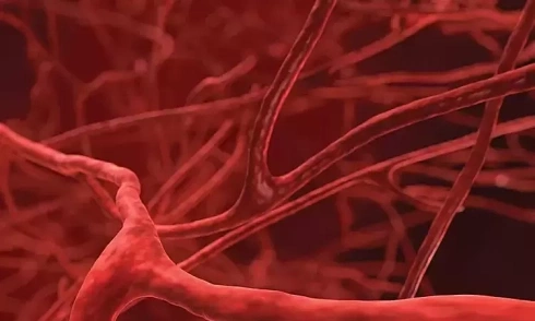 Woman thought headaches were vestibular disorder, discovered brain aneurysm at risk of rupture