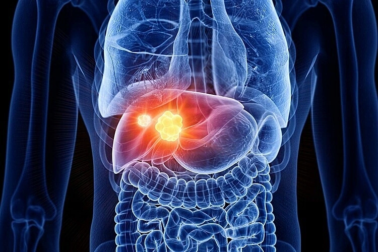 Man diagnosed with two dangerous cancers simultaneously