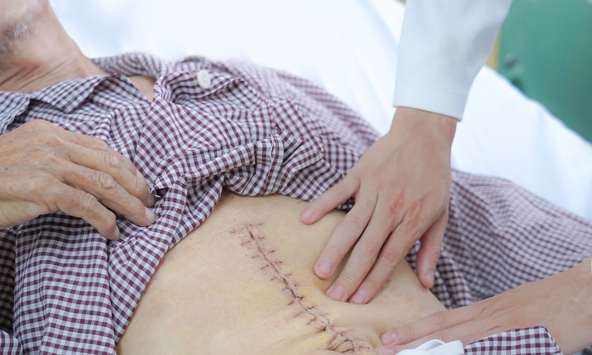 Removing a 'ticking time bomb' from a man's abdomen