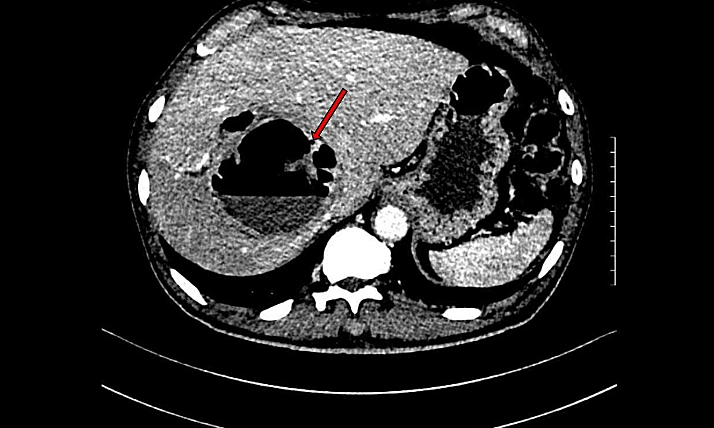 Man found with orange-sized liver abscess