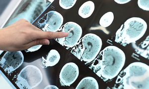 Missing the "golden hour" for stroke emergency due to self-medication