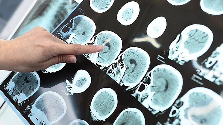 Missing the "golden hour" for stroke emergency due to self-medication