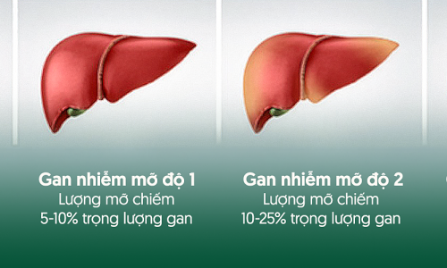 The progression of fatty liver disease