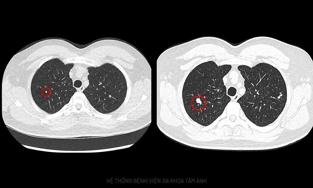AI application for early lung cancer detection