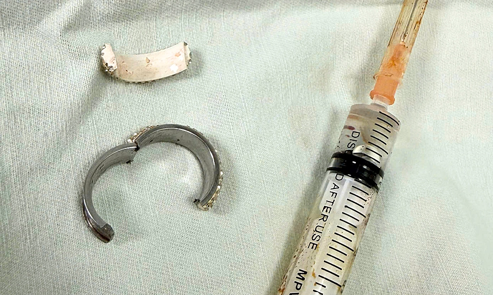 Man faces crisis after wearing ring on genitals