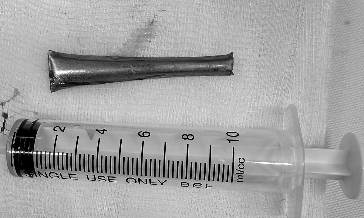 Spoon handle lodged in man's bronchus for a month