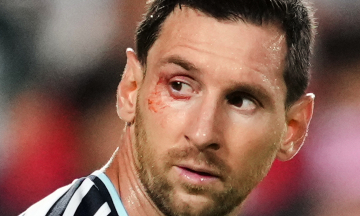 Why did Messi's eye bleed in Argentina's win over Switzerland?