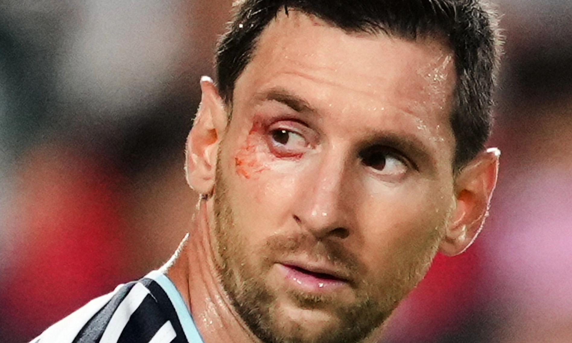 Why did Messi's eye bleed in Argentina's win over Switzerland?