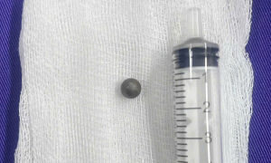 Iron marble deeply embedded in boy's head, threatening his life