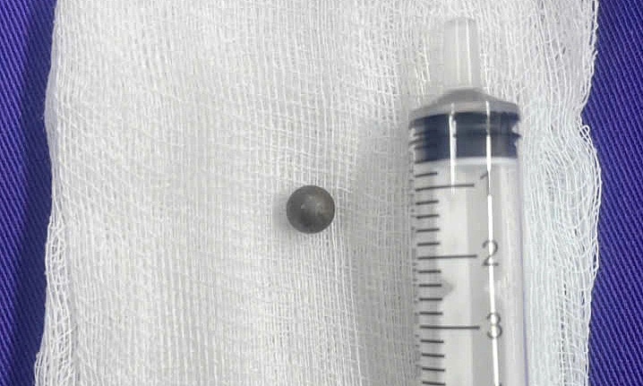 Iron marble deeply embedded in boy's head, threatening his life