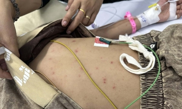 Meningococcal disease can become severe within hours of headache onset