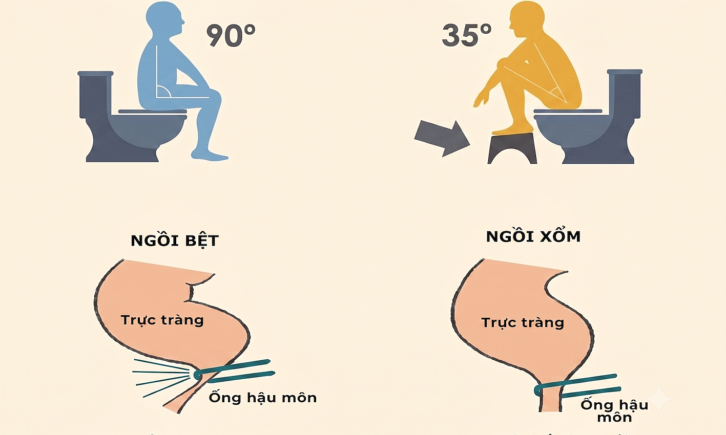 Should you use a footstool when defecating?