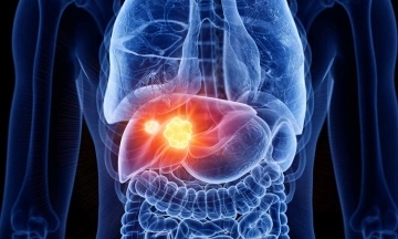 Self-treating liver cancer with traditional medicine leads to 3,5 kg tumor