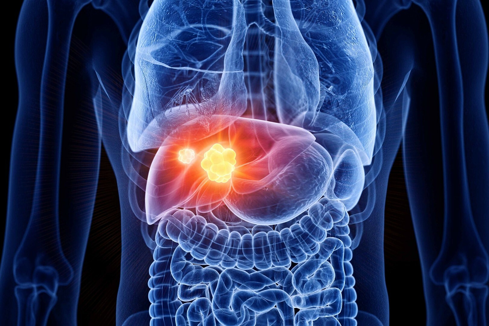 Self-treating liver cancer with traditional medicine leads to 3,5 kg tumor
