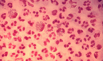 Man Contracts Gonorrhea After First Intimate Encounter With Year-Long Girlfriend
