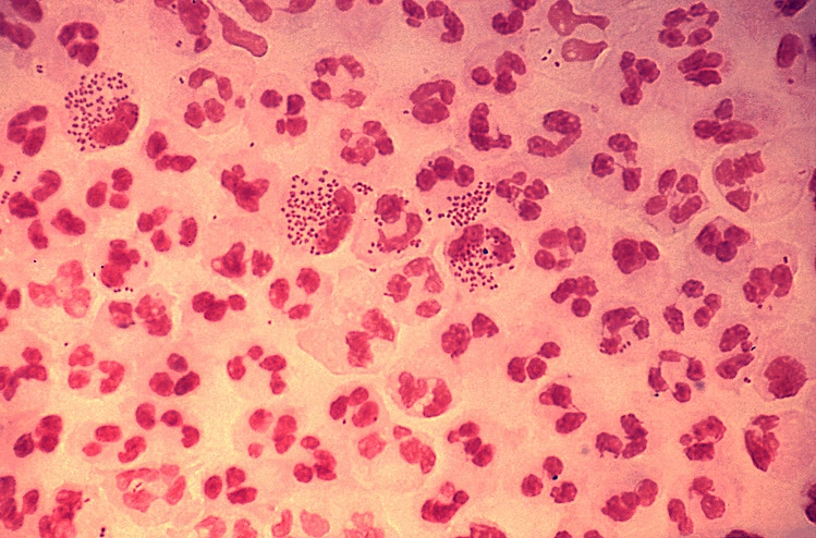 Man Contracts Gonorrhea After First Intimate Encounter With Year-Long Girlfriend