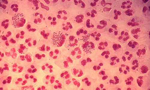 Man Contracts Gonorrhea After First Intimate Encounter With Year-Long Girlfriend