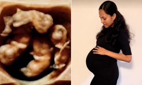 Natural identical quadruplets: a one in 15 million rarity