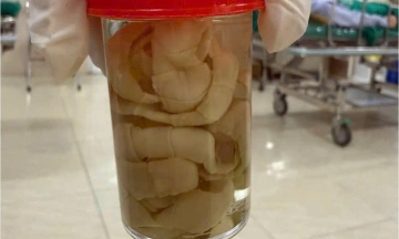 1.2-meter tapeworm found parasitic in man's abdomen