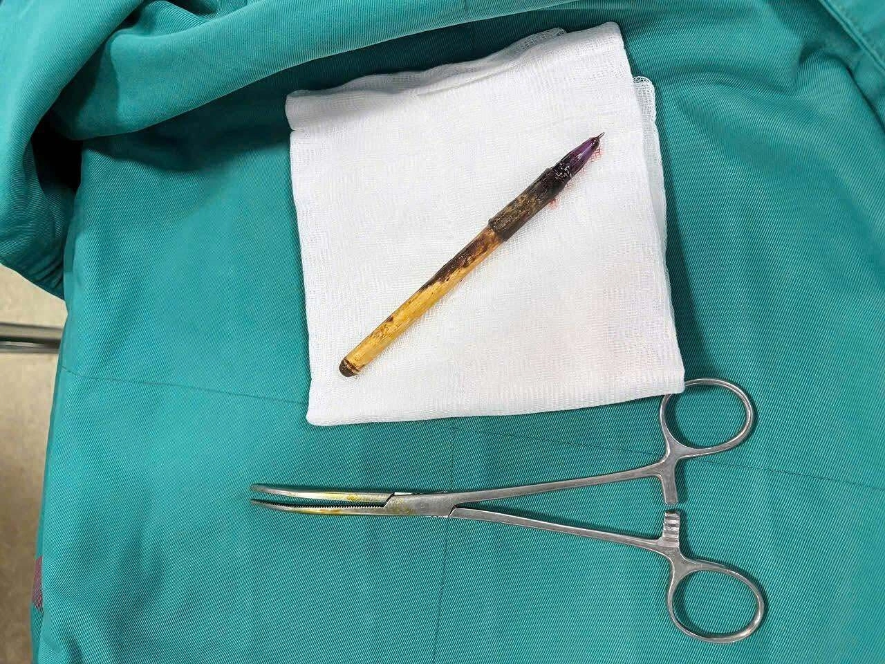 Mysterious ballpoint pen pierces boy's colon