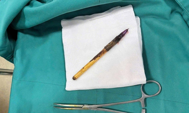 Mysterious ballpoint pen pierces boy's colon