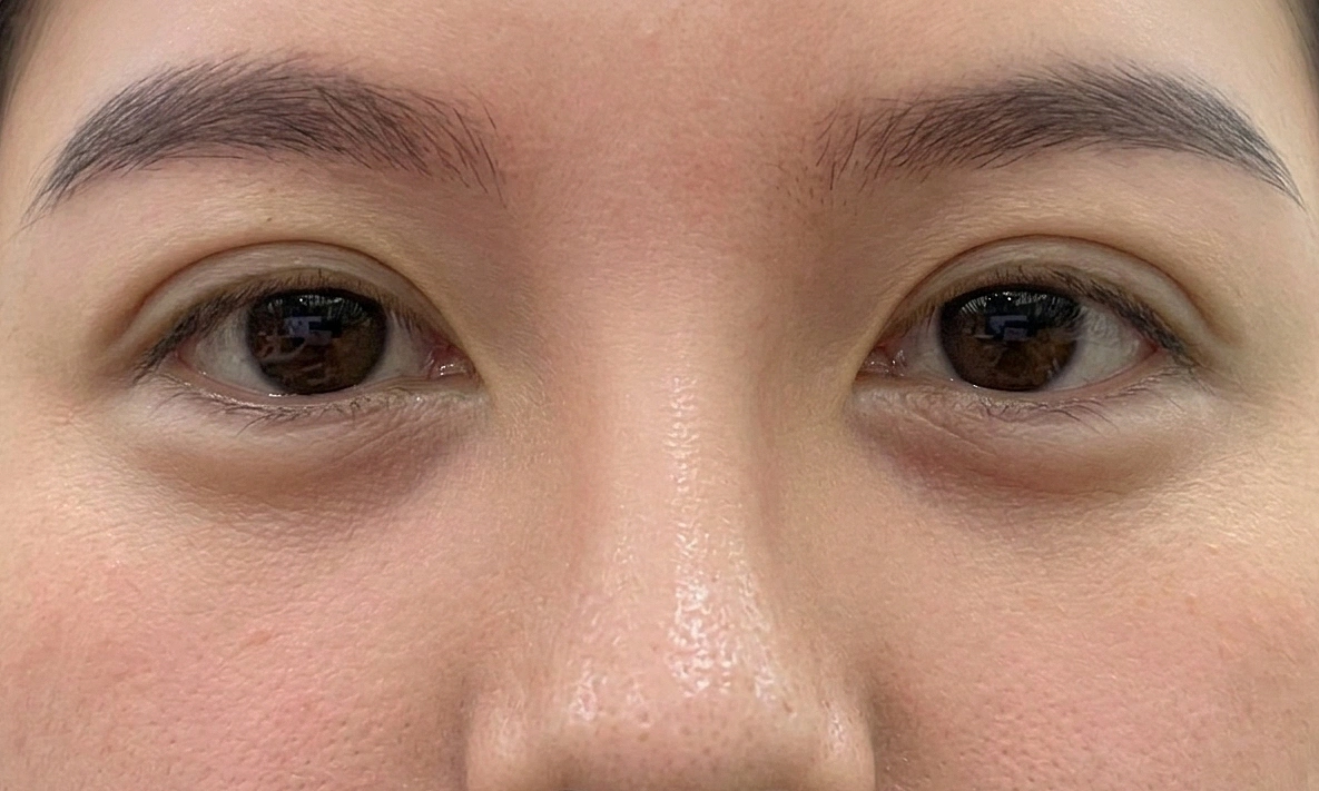 5 eye signs that warn of liver and kidney disease