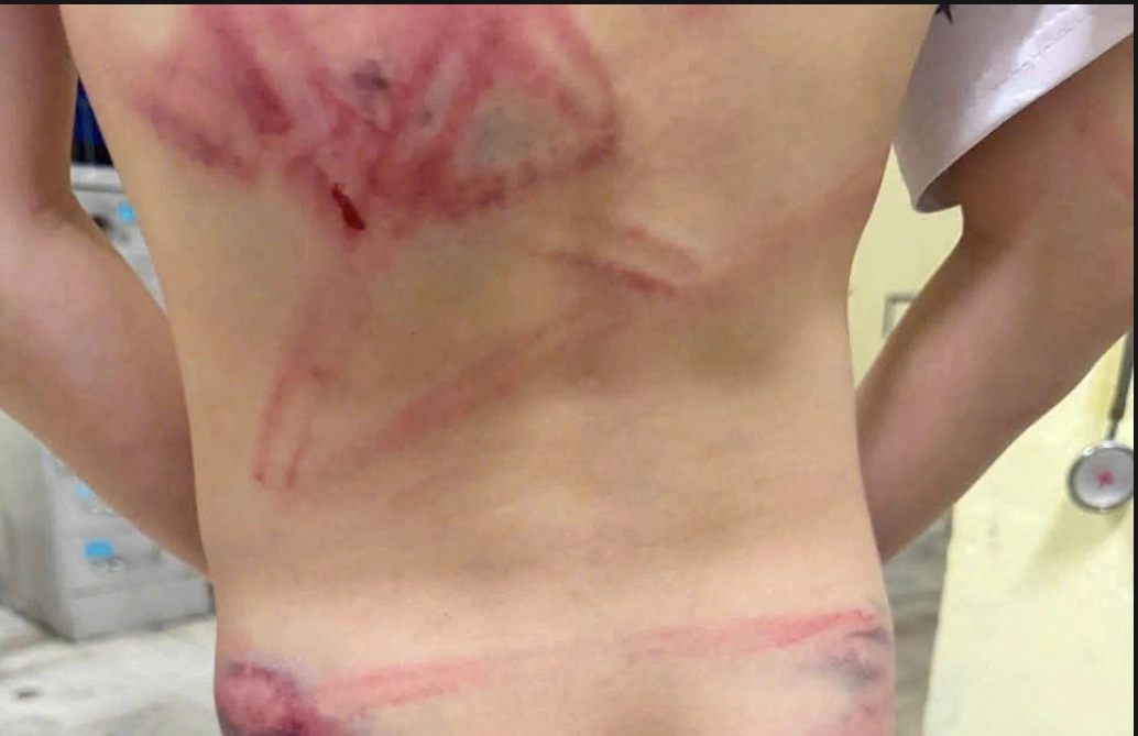 Father beats 9-year-old son, hospitalizing him for forgetting school bag