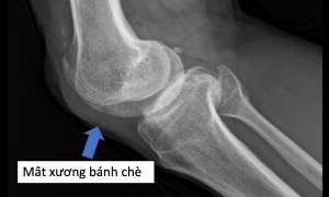 Vascular reconnection saves veteran's leg after 50 years of kneecap loss