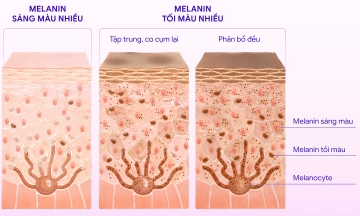 How melasma forms