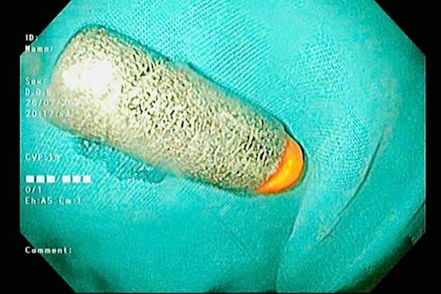 5-year-old boy inserts toy bullet through anus into rectum