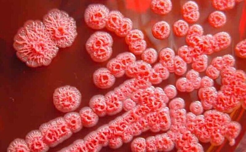 Parotid abscess leads to unexpected discovery of "flesh-eating bacteria" infection
