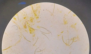 Threadworms carrying bacteria attack man's brain