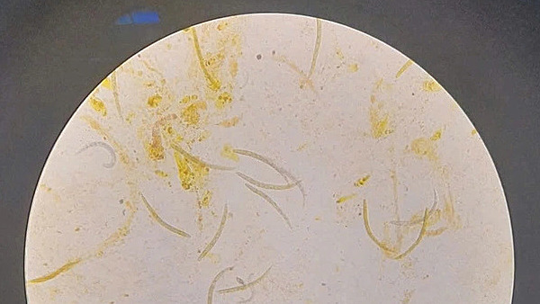 Threadworms carrying bacteria attack man's brain