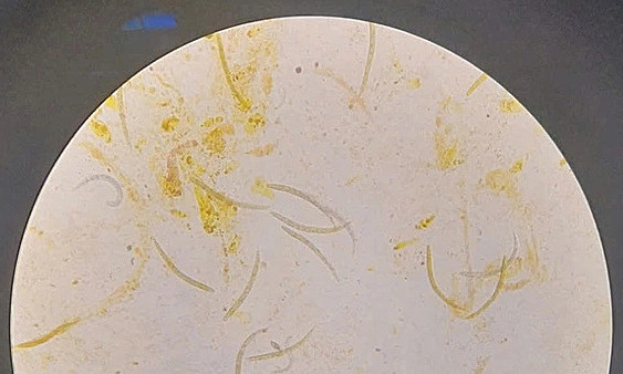 Threadworms carrying bacteria attack man's brain