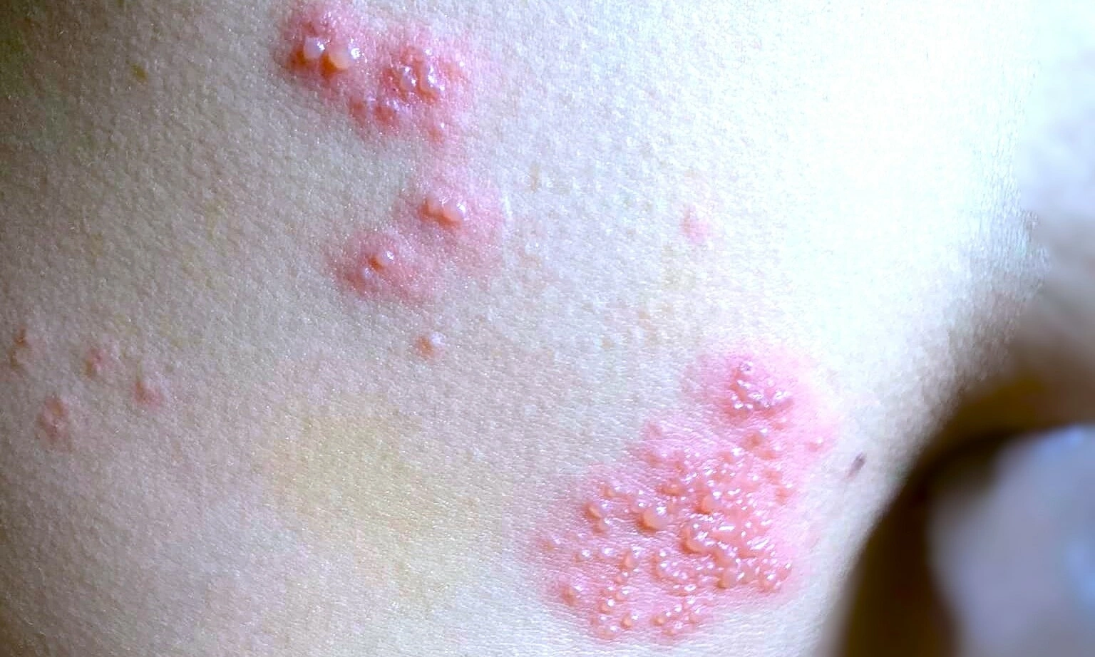 Fear of shingles recurrence leads to exhaustion