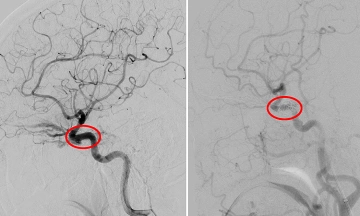 Eye protrusion, vision loss linked to brain vascular fistula