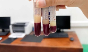 Plasma turns milky white: A stark warning of severe health risks