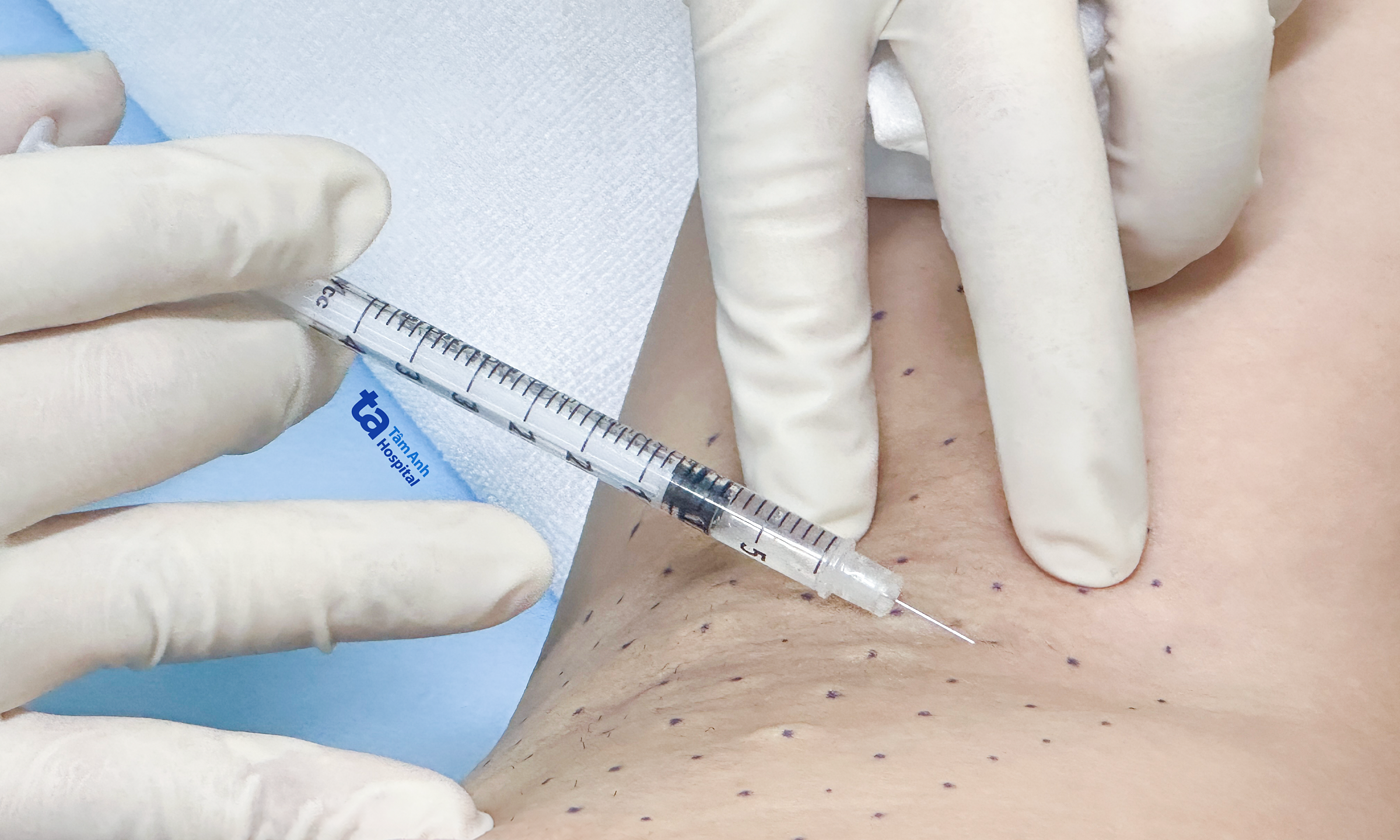 Postpartum underarm botox treatment for excessive sweating