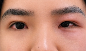 Differentiating between viral and bacterial conjunctivitis