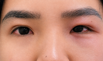 Differentiating between viral and bacterial conjunctivitis