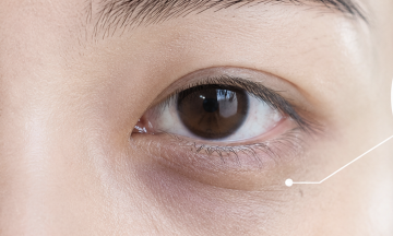 Why do dark circles appear even with enough sleep?