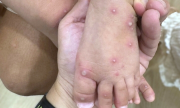 Should children be kept home from school when there is a hand, foot, and mouth case in class?