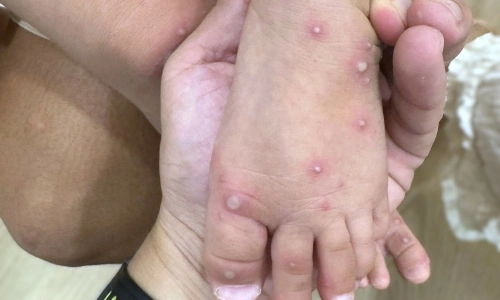 Should children be kept home from school when there is a hand, foot, and mouth case in class?