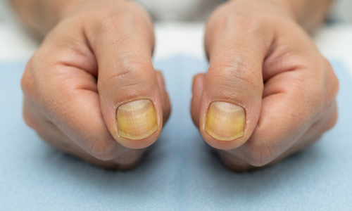 Unusual nail signs warn of disease