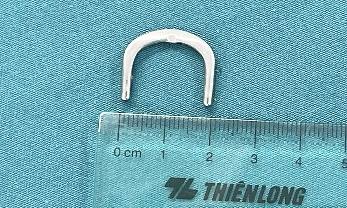 3-year-old girl has watch buckle stuck in duodenum