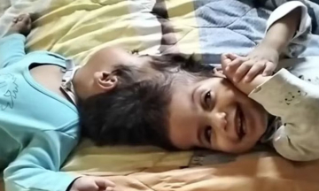 Last-minute complication leads to death of conjoined twins on operating table