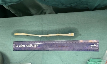 Nerve segment from tissue bank grafted for worker after industrial accident