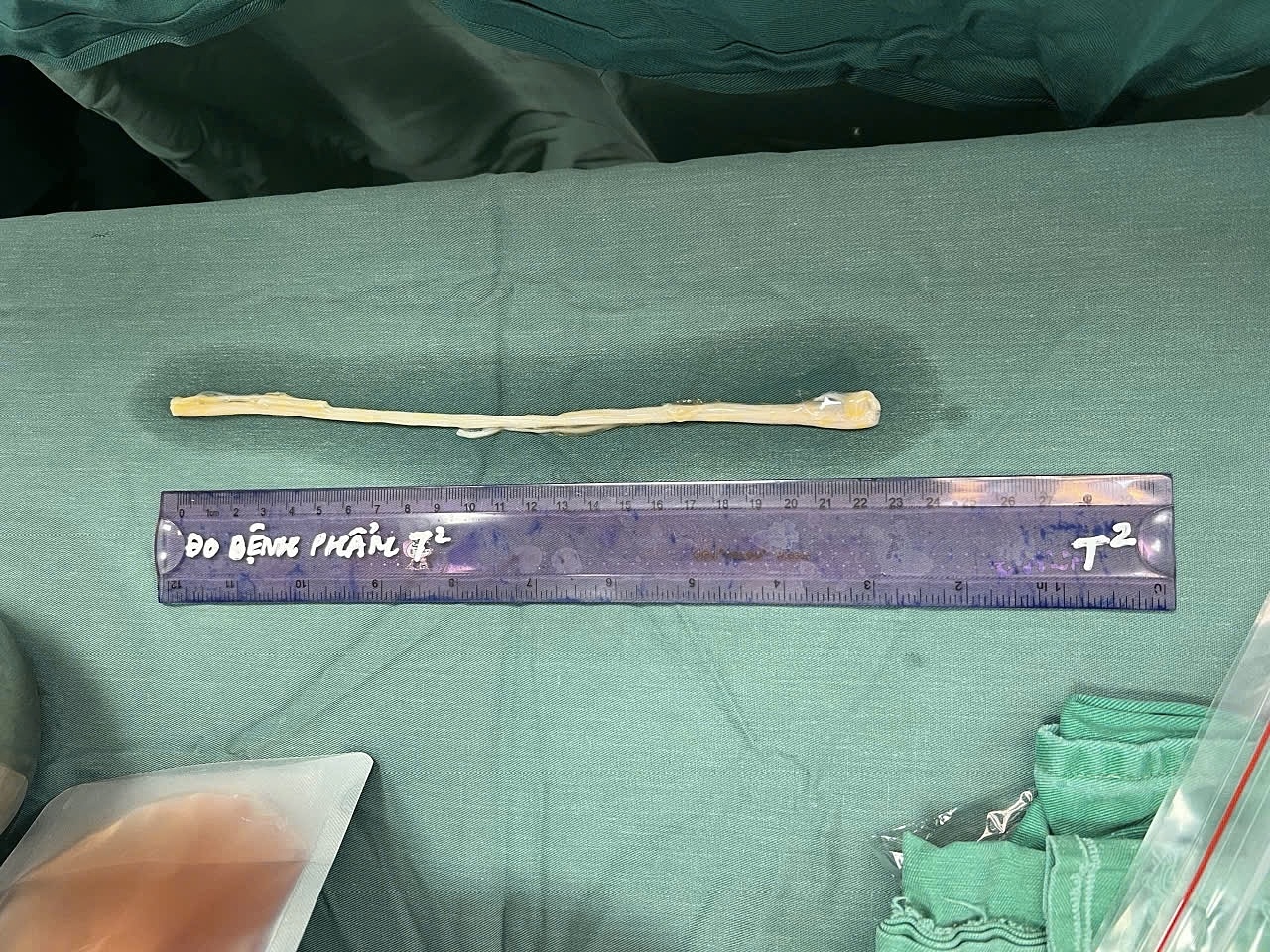 Nerve segment from tissue bank grafted for worker after industrial accident