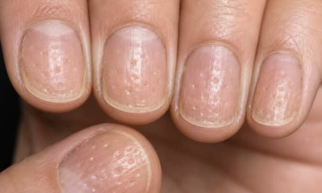 Unusual nail signs warn of underlying diseases